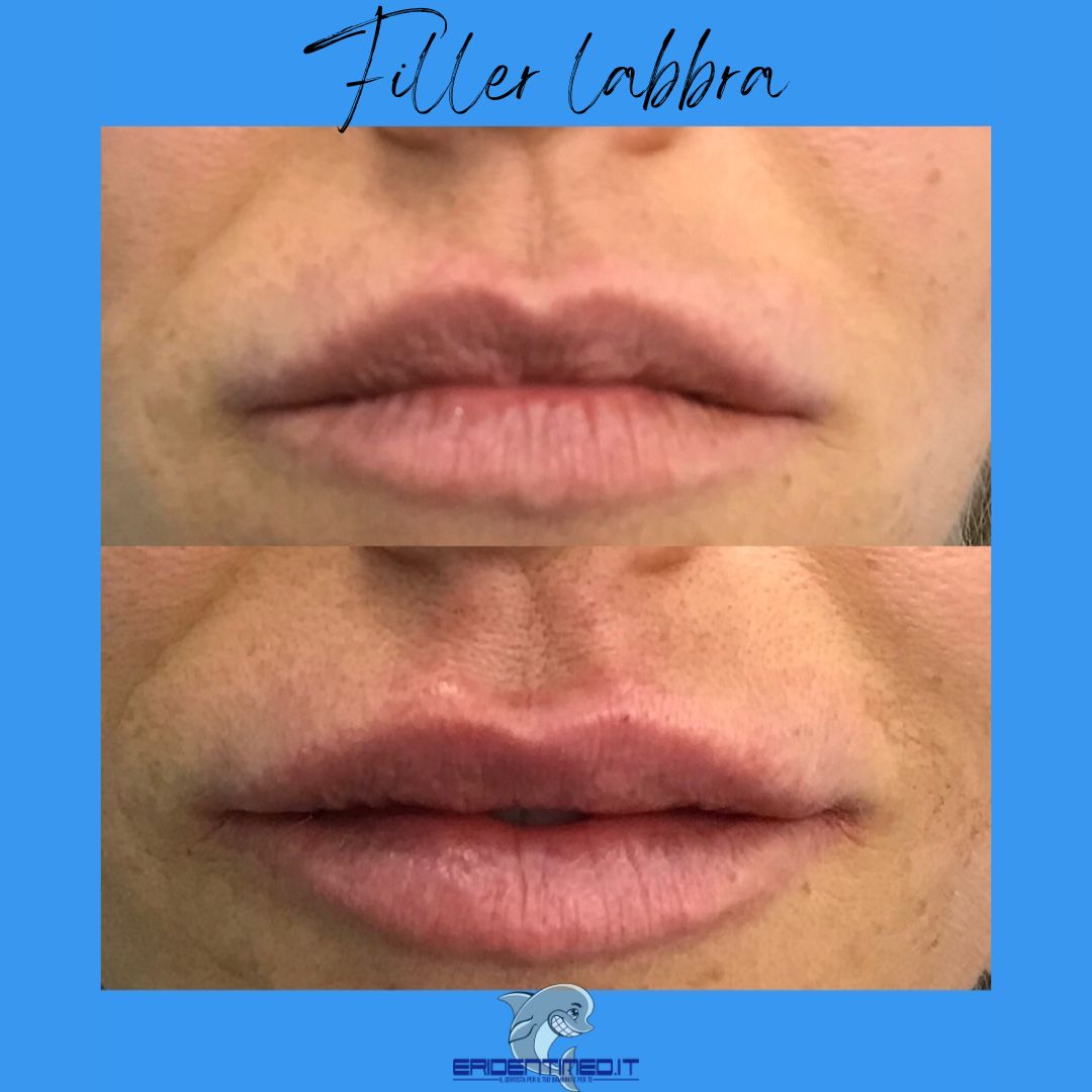 Filler labbra.jpg