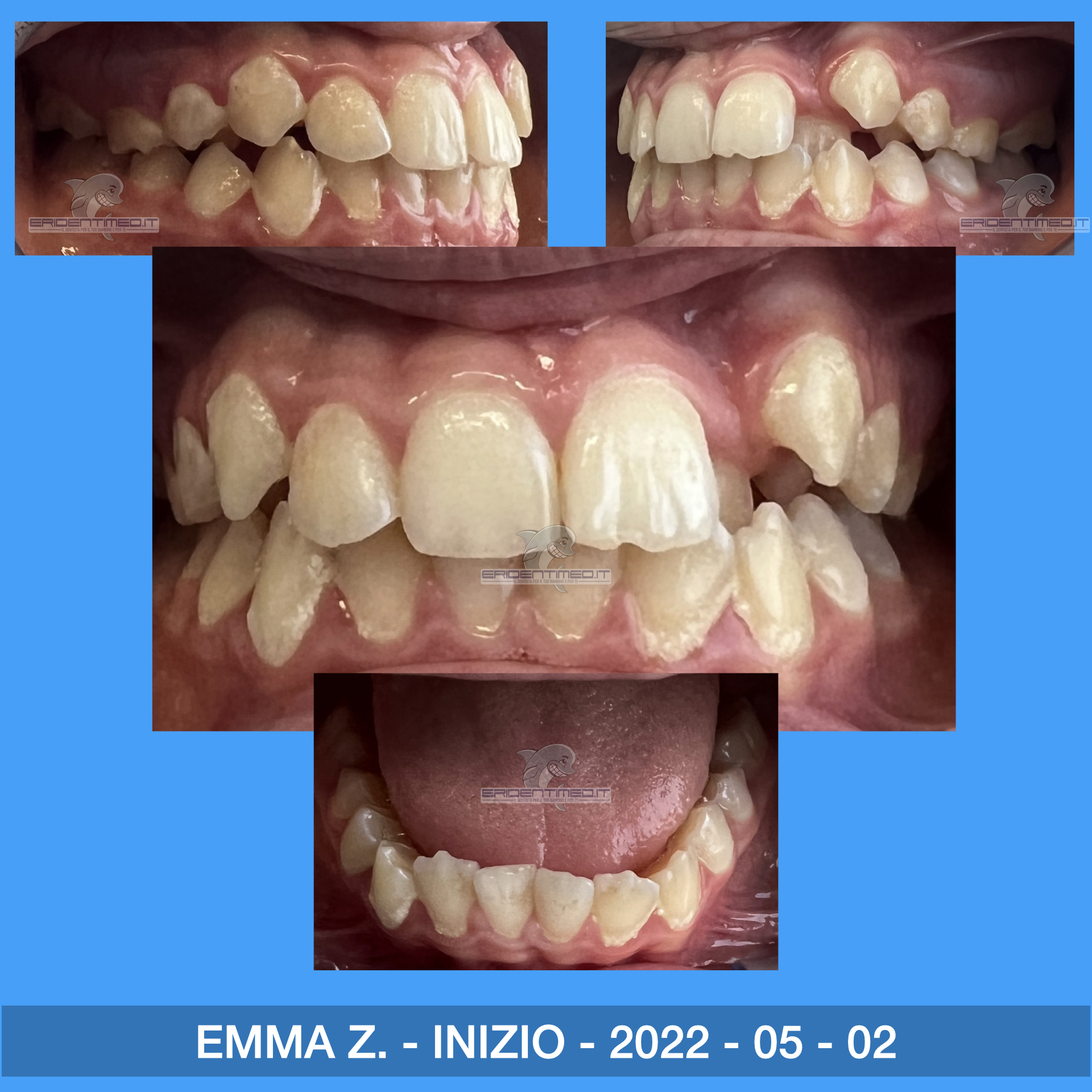 PRIMA E DOPO ZECCA EMMA.001.jpeg